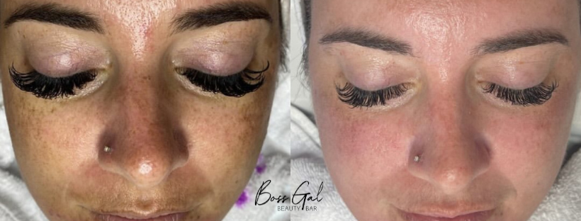 Your Guide to Fading Hyperpigmentation