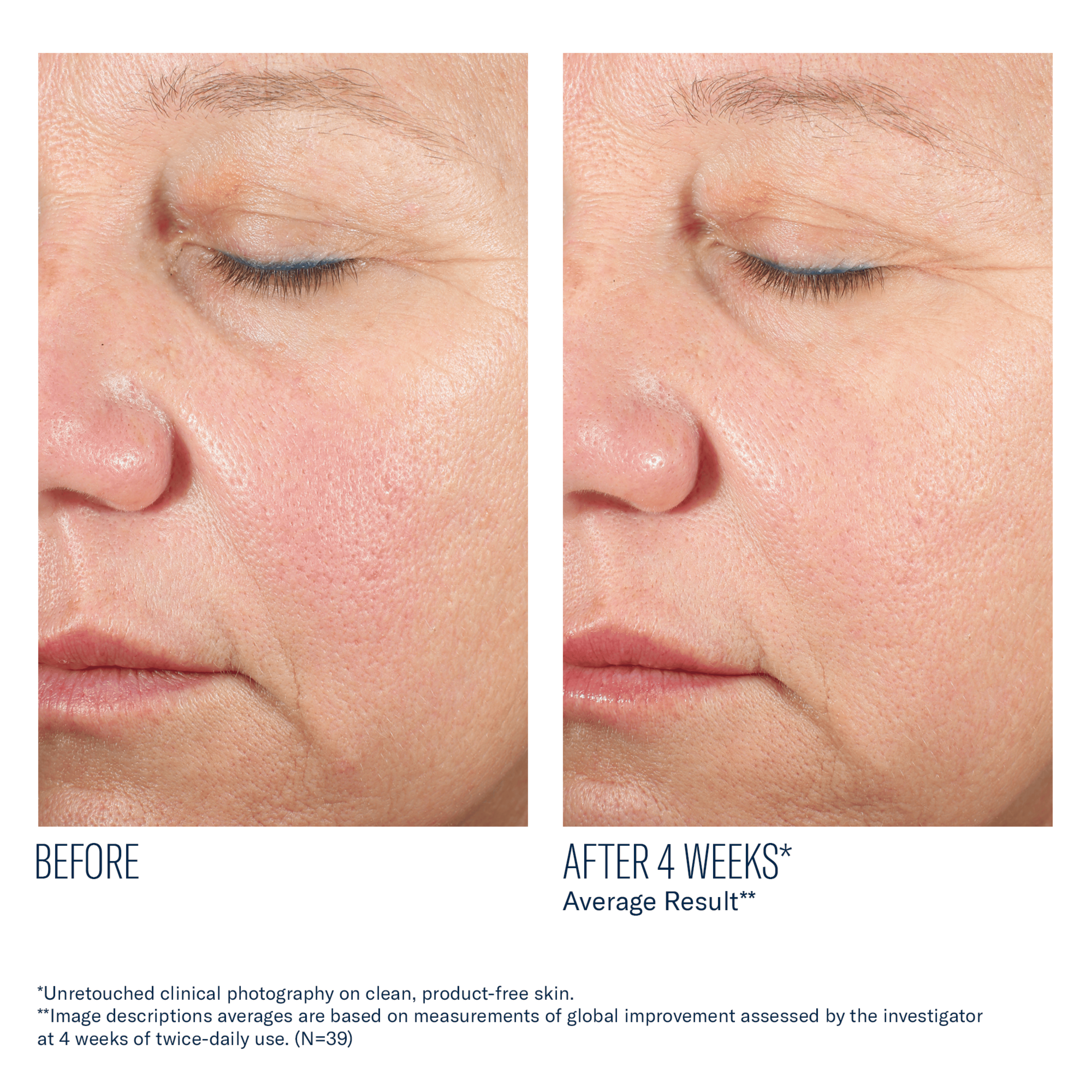 Before and after comparison of facial skin with visible improvement after 4 weeks.