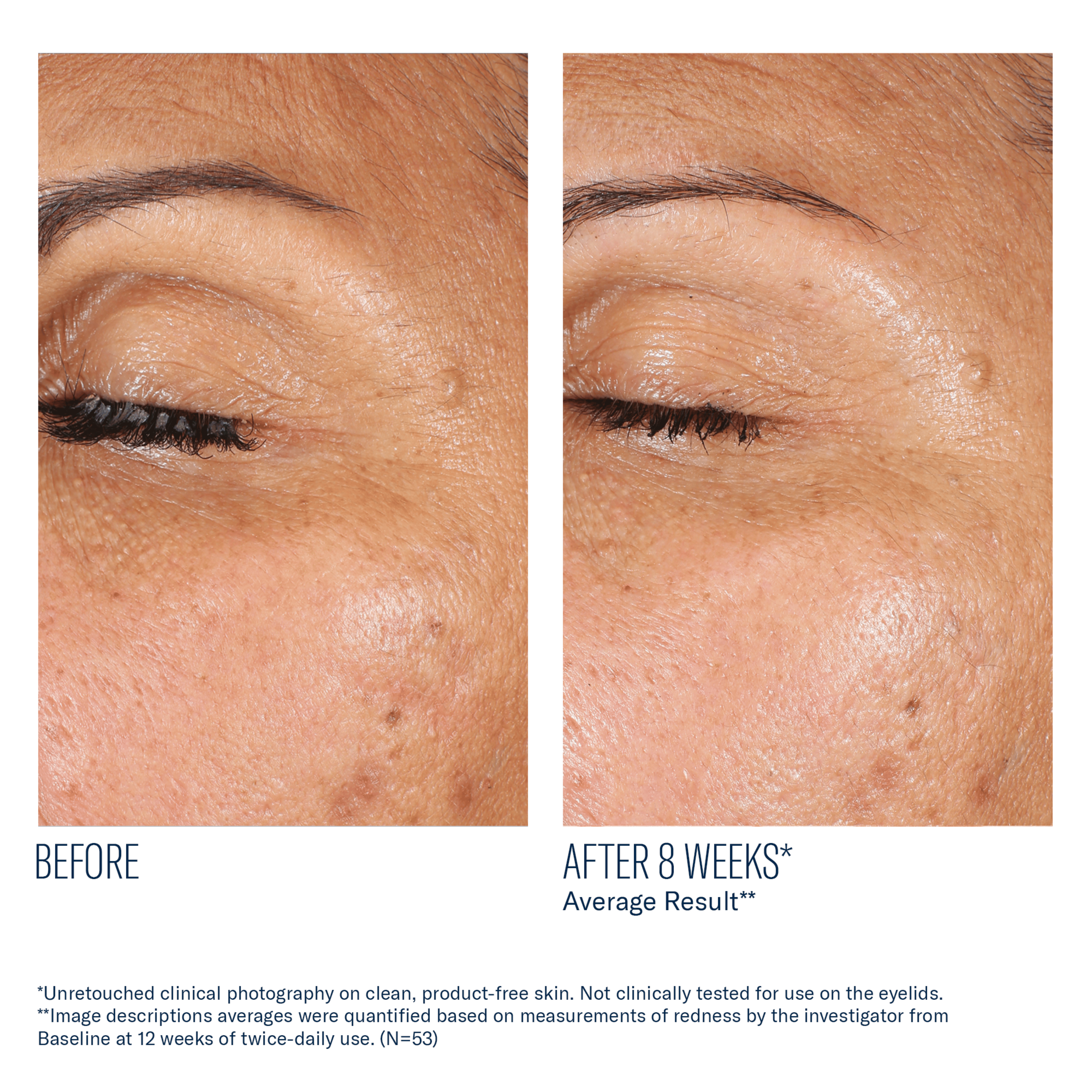 Before and after comparison of eye area skin texture on a person's eyelid.