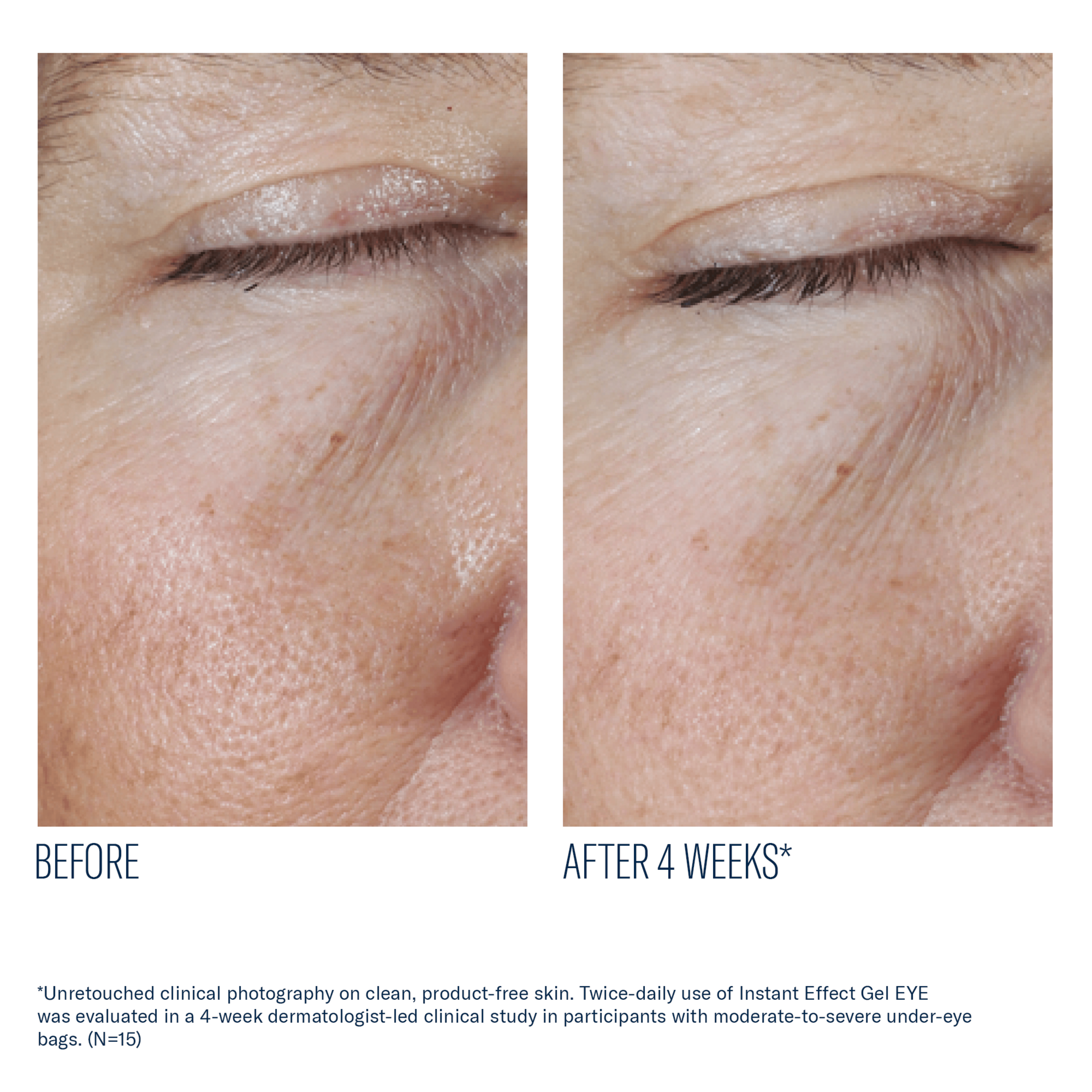 Before and after comparison of under-eye skin texture with text indicating a 4-week treatment period.