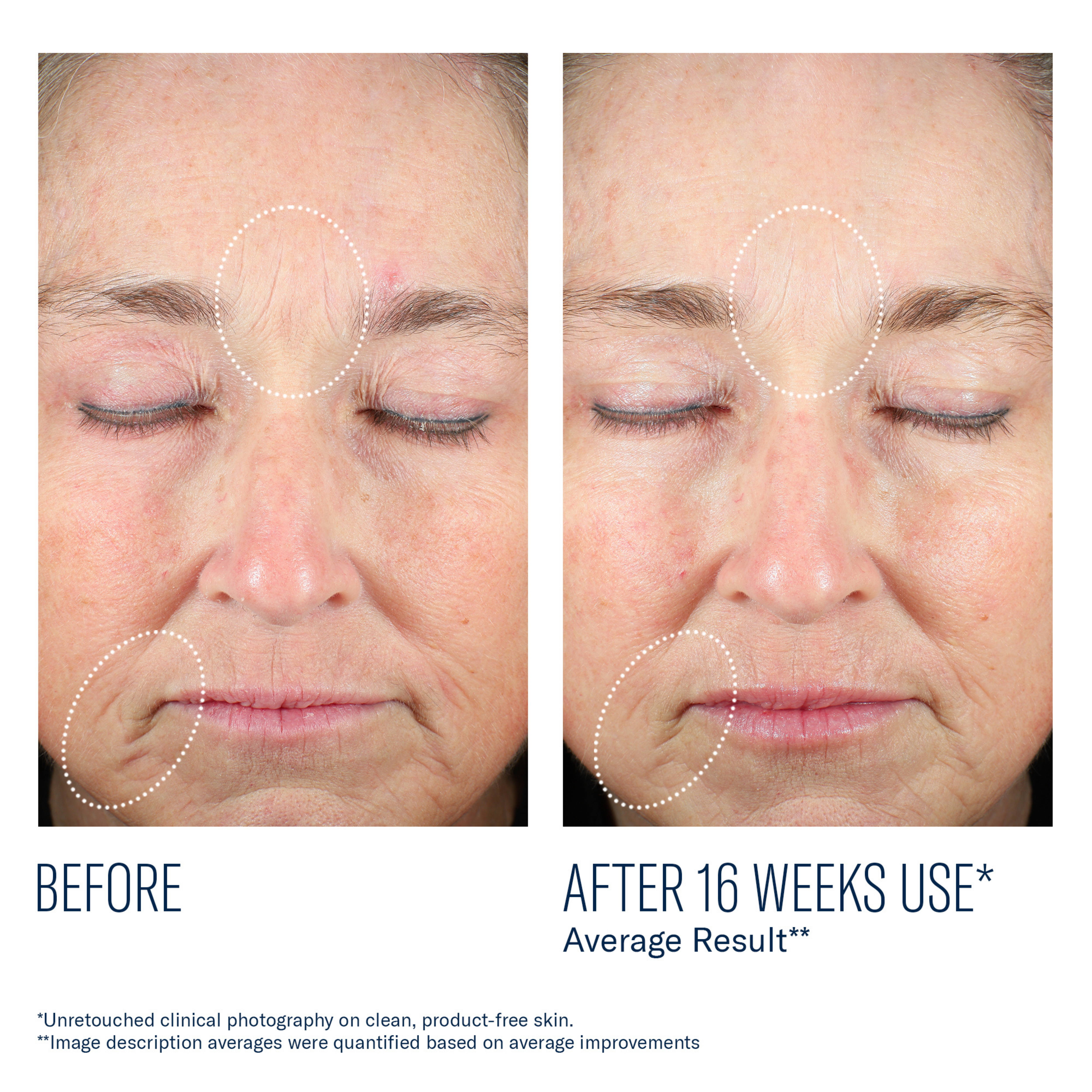 Before and after comparison of facial skin with visible improvements on a white background