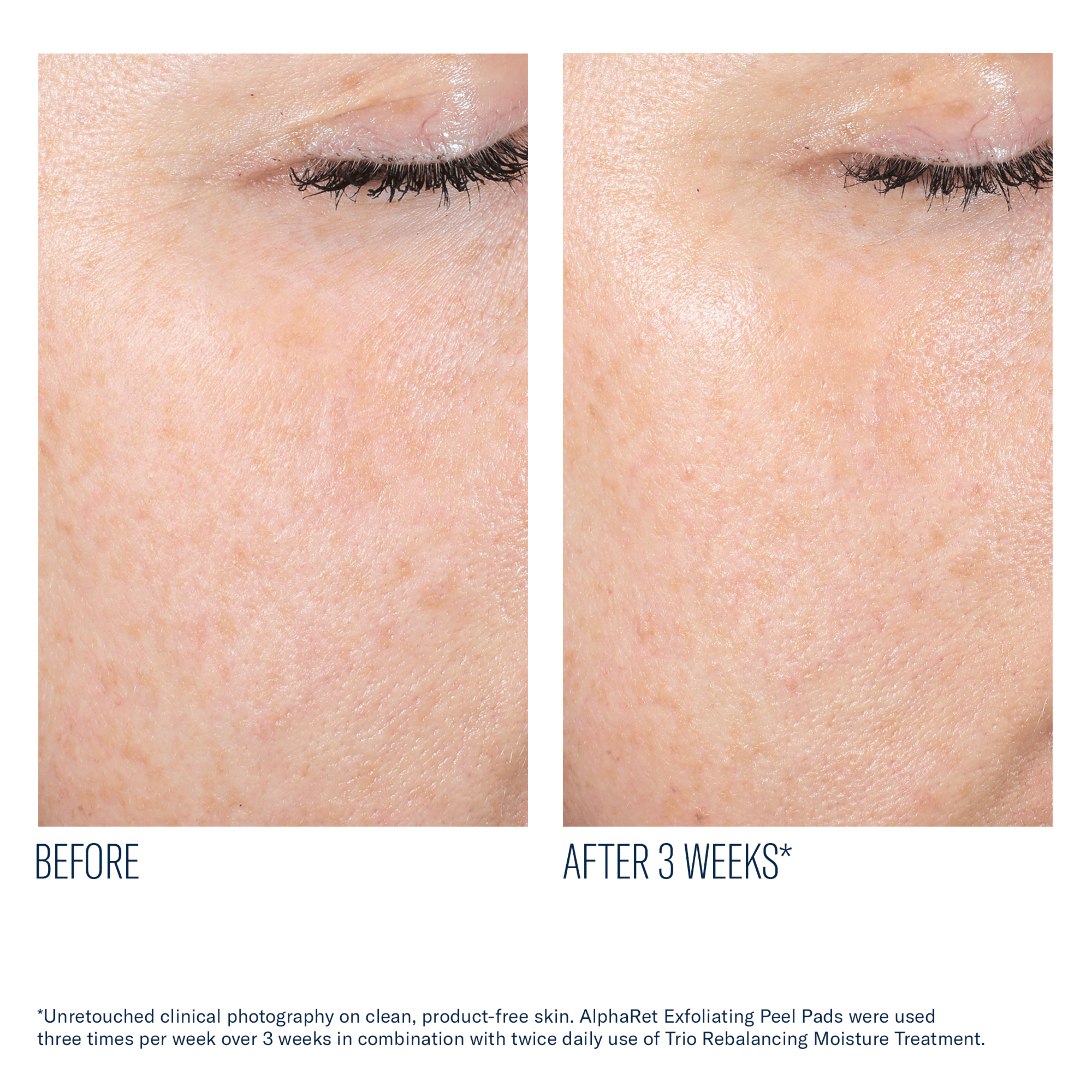 Before and after comparison of skin texture with AlphaRet Exfoliating Peel Pads over 3 weeks.