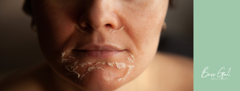 Shed the Dead: How Chemical Peels Improve Your Skin