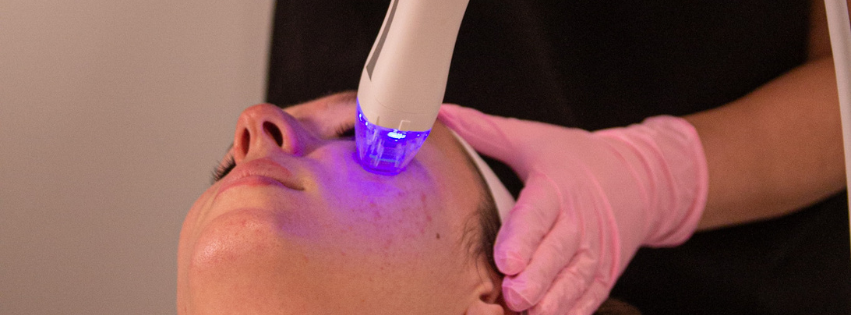 Microneedling for Acne Scars: Diminishing Blemishes and Pockmarks