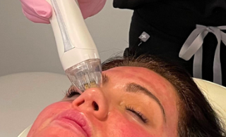 Treating Acne Scars