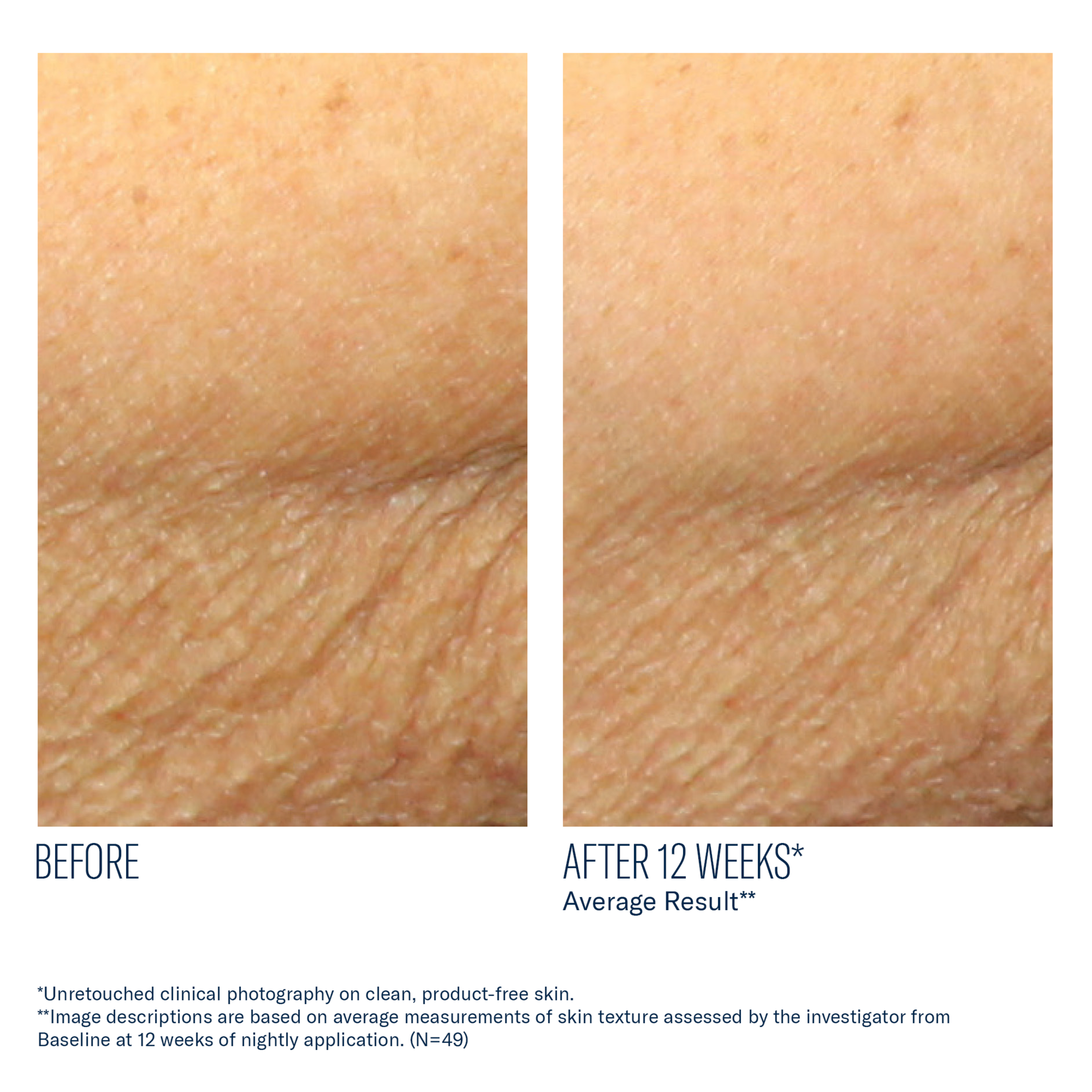 Before and after comparison of skin texture improvement after 12 weeks, showing a smoother appearance.
