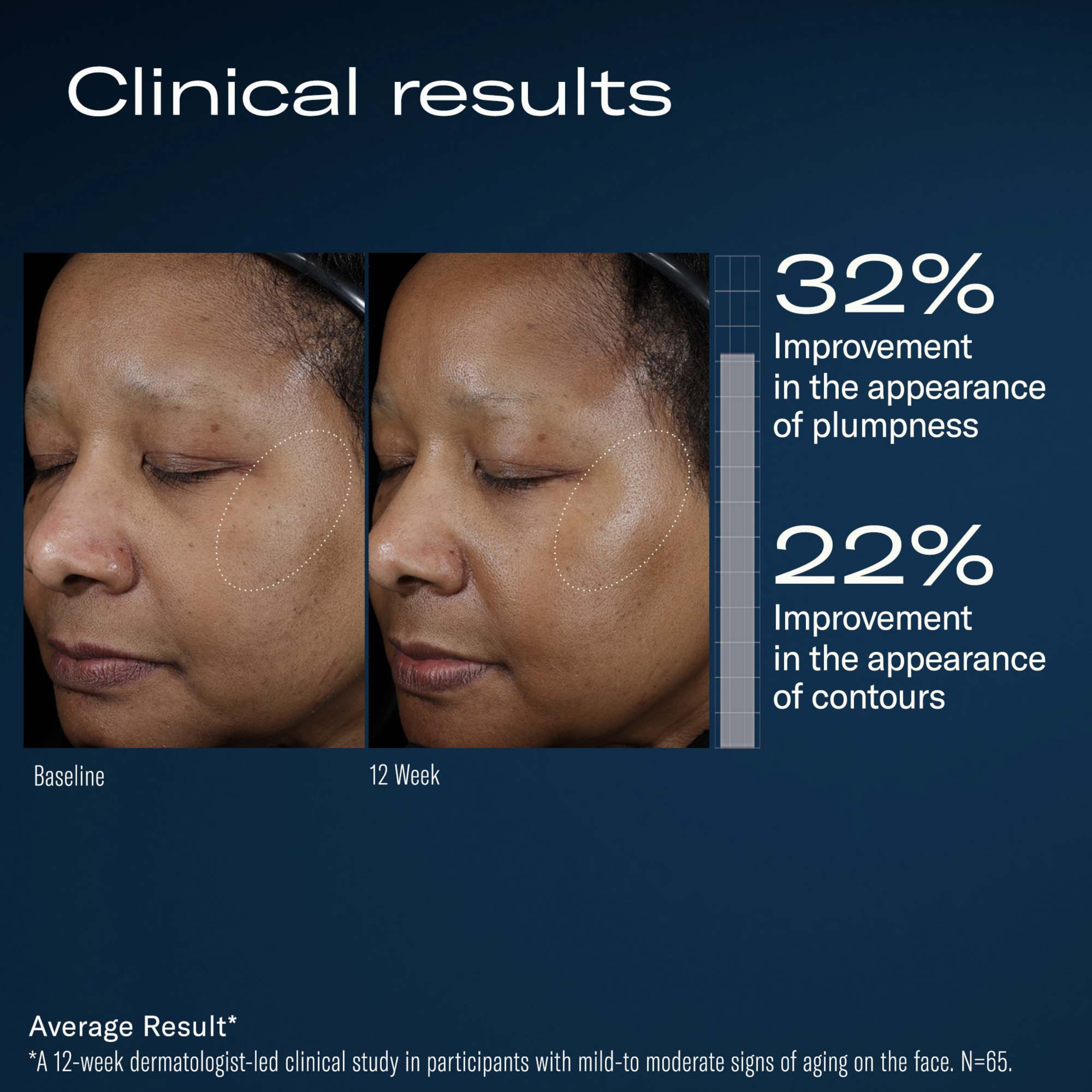 Before and after clinical results of a skincare treatment showing improvements in plumpness and contours.