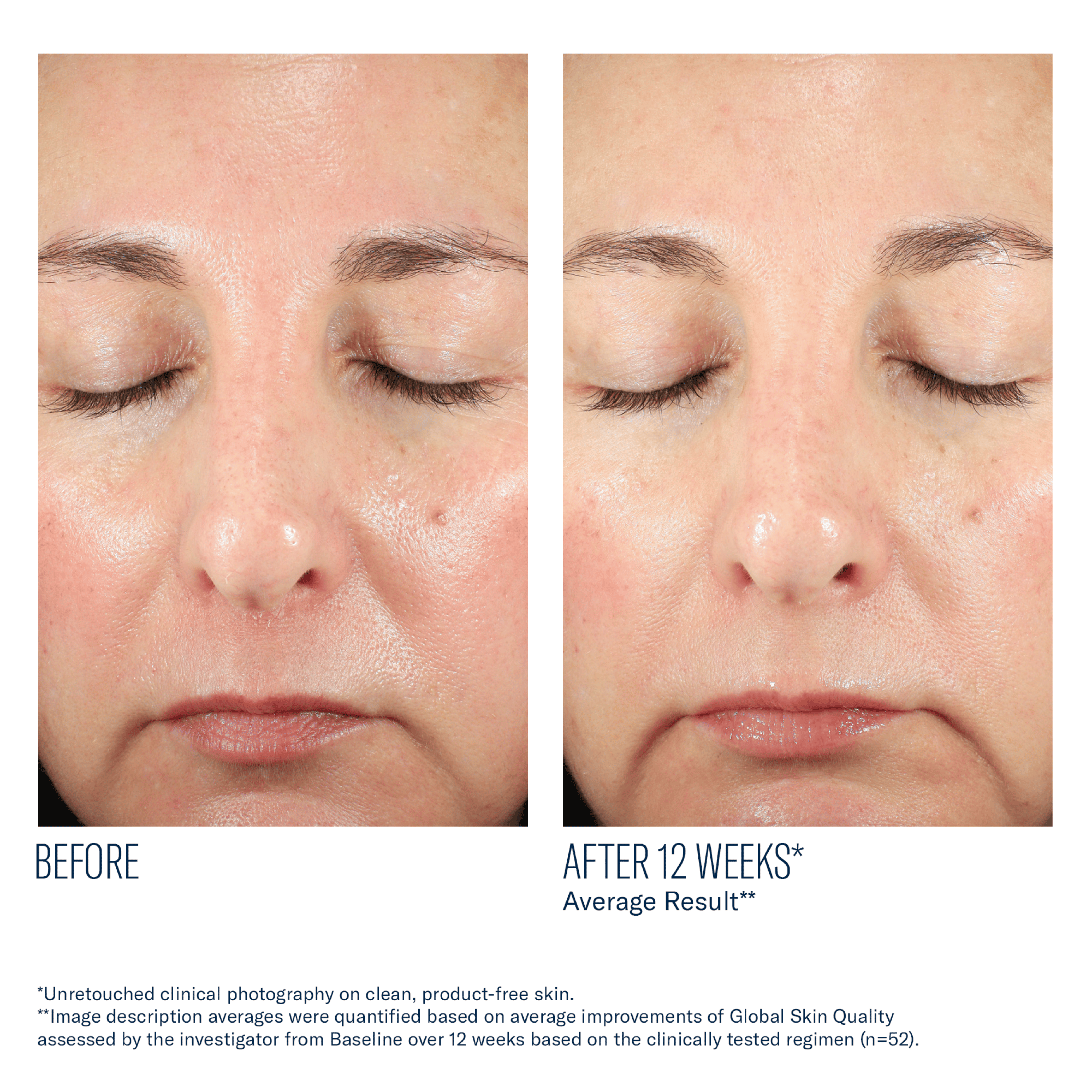 Before and after comparison of a woman's face with closed eyes, showing skin improvement over 12 weeks.