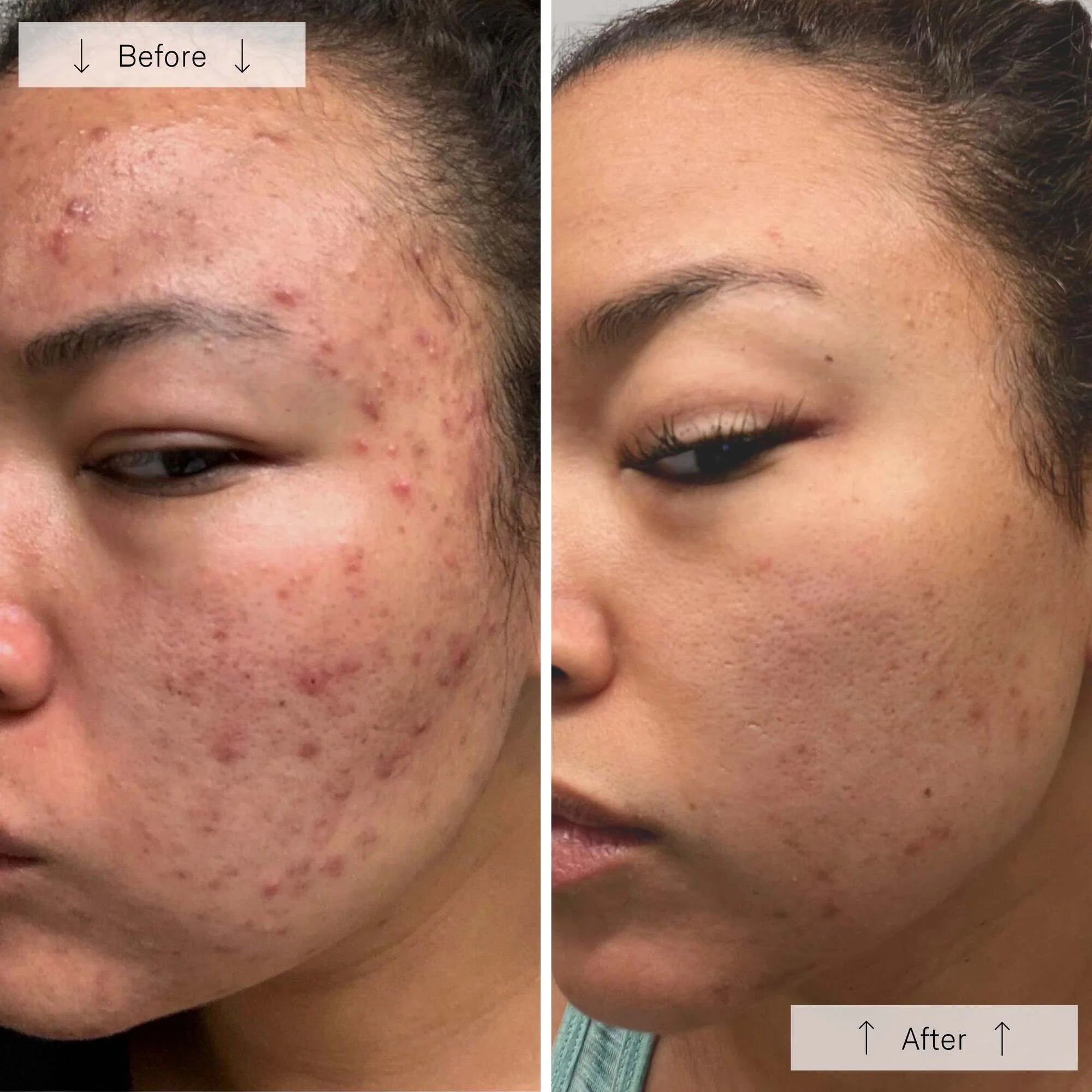 Before and after comparison of a person's face with acne on the left and clearer skin on the right.