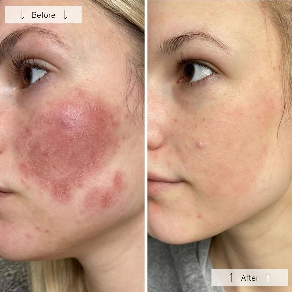 Before and after comparison of a person's face with visible skin condition improvement.