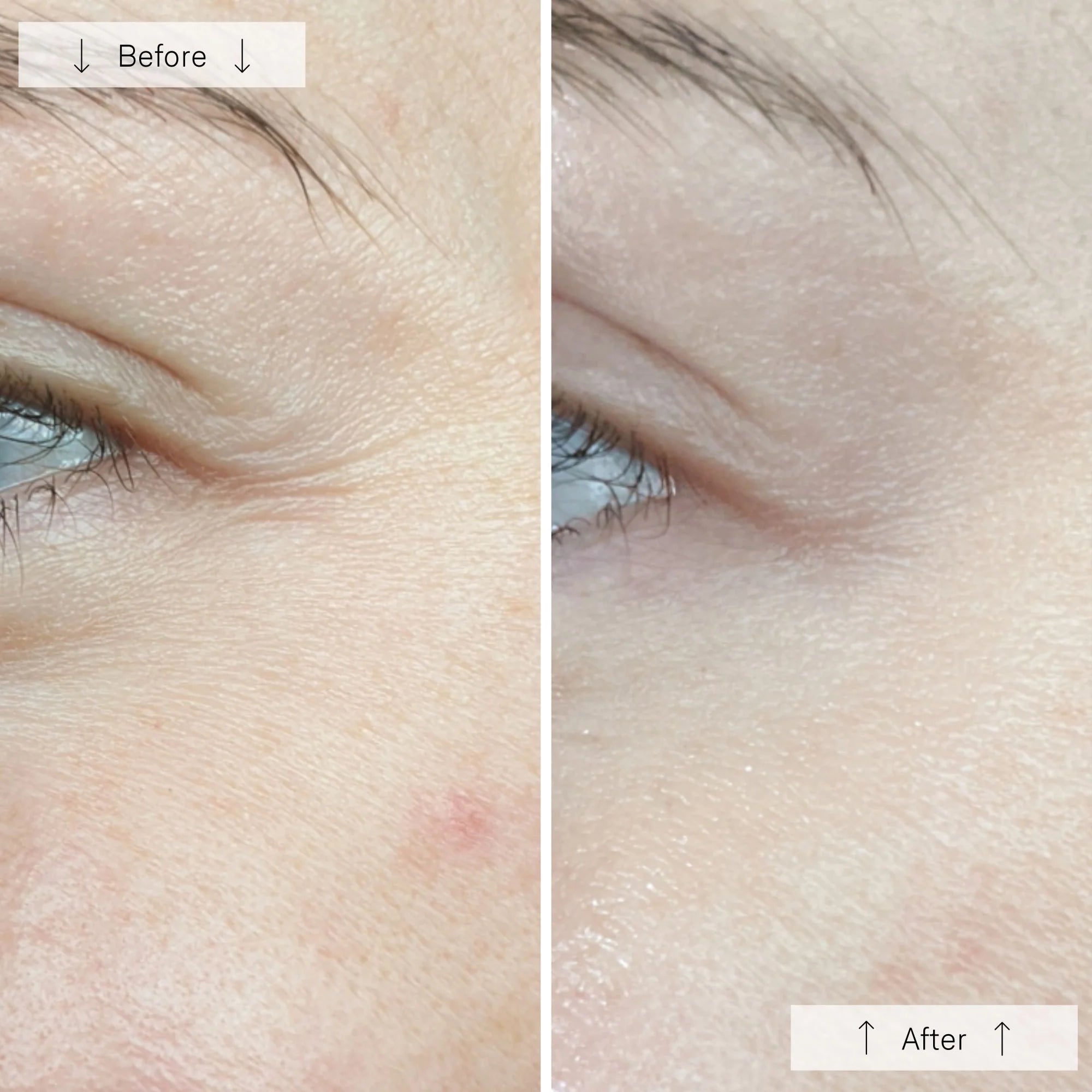 Before and after comparison of eye area skin texture and wrinkle reduction.