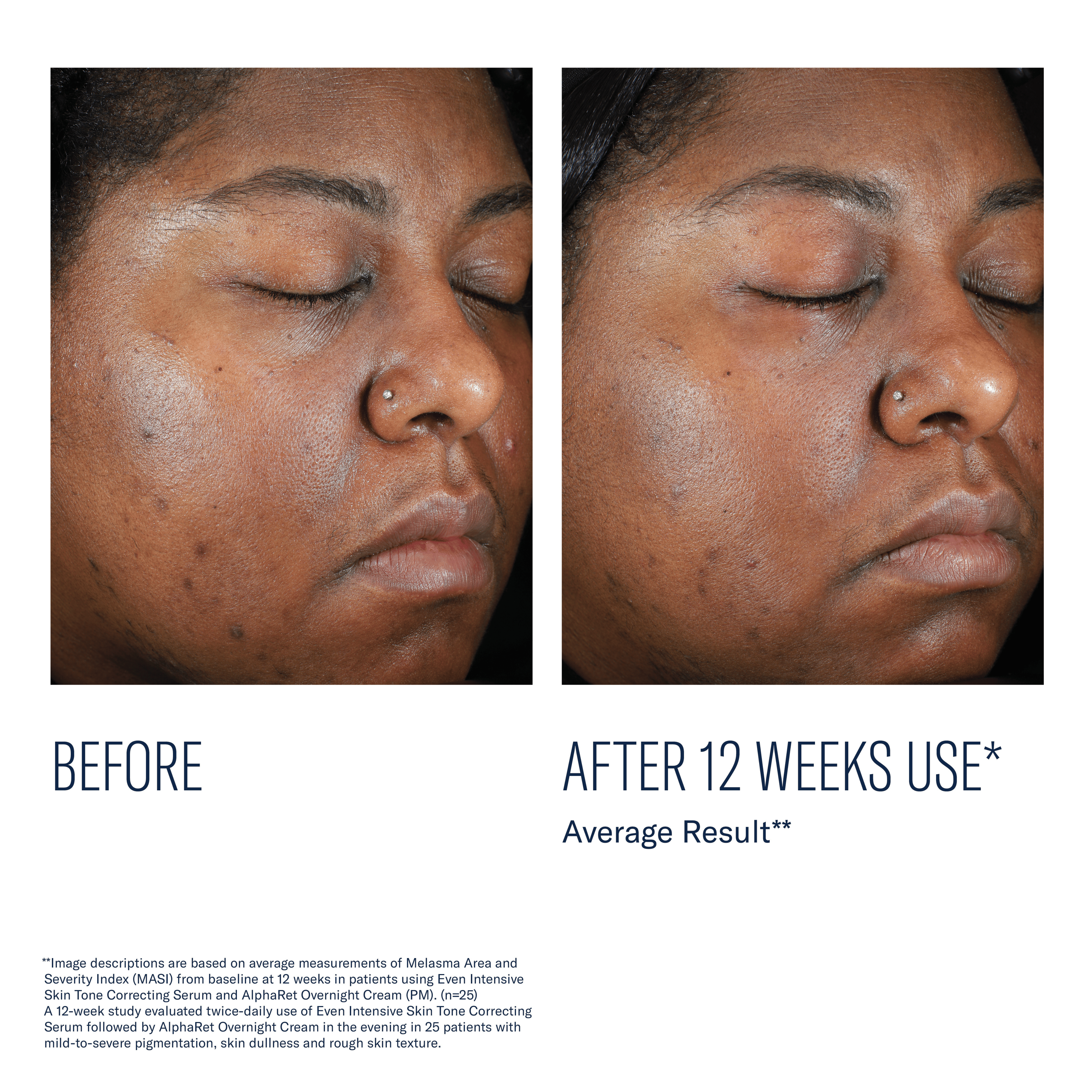Before and after comparison of a person's face with text indicating 12 weeks of use.