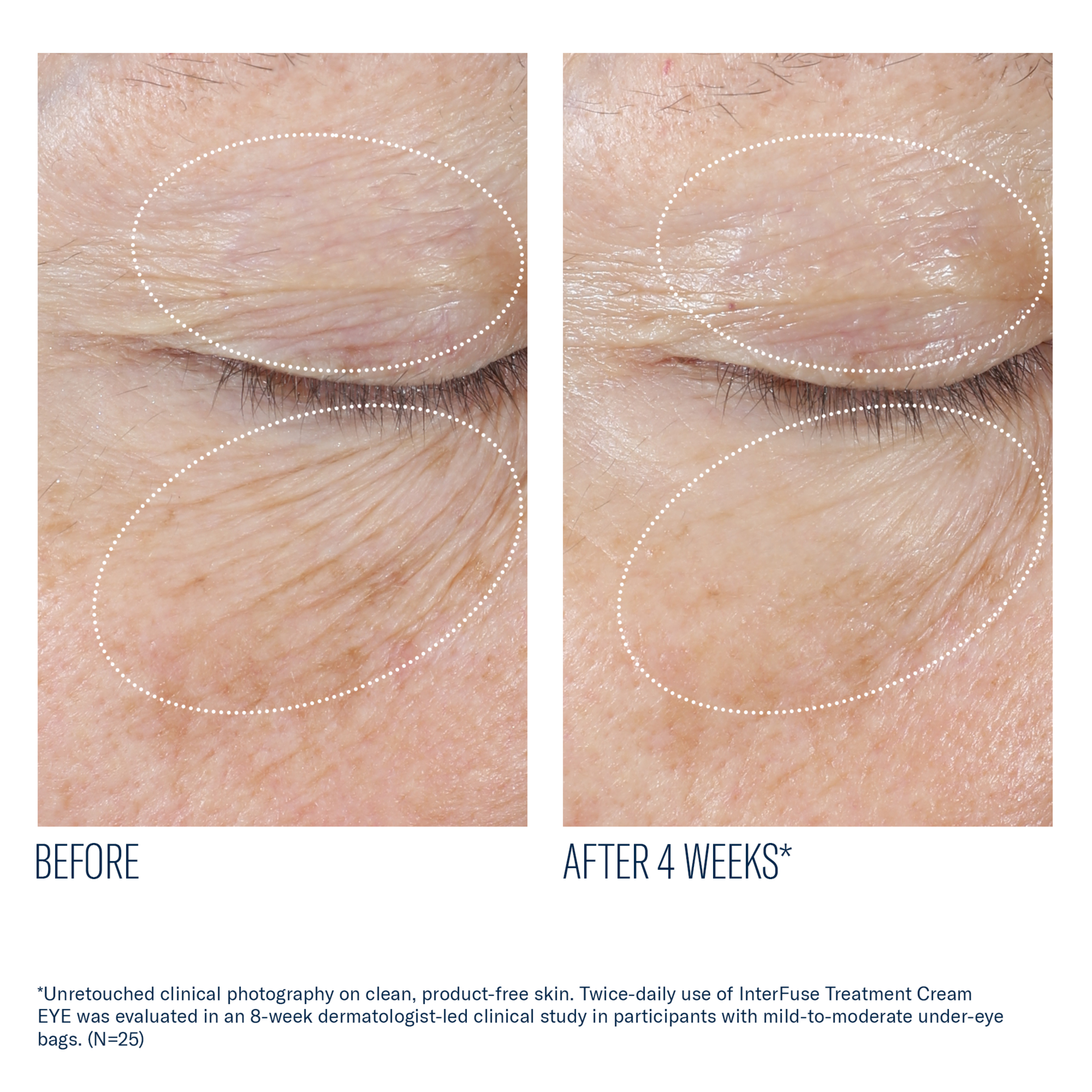 Before and after comparison of under-eye skin treatment showing reduced bags.