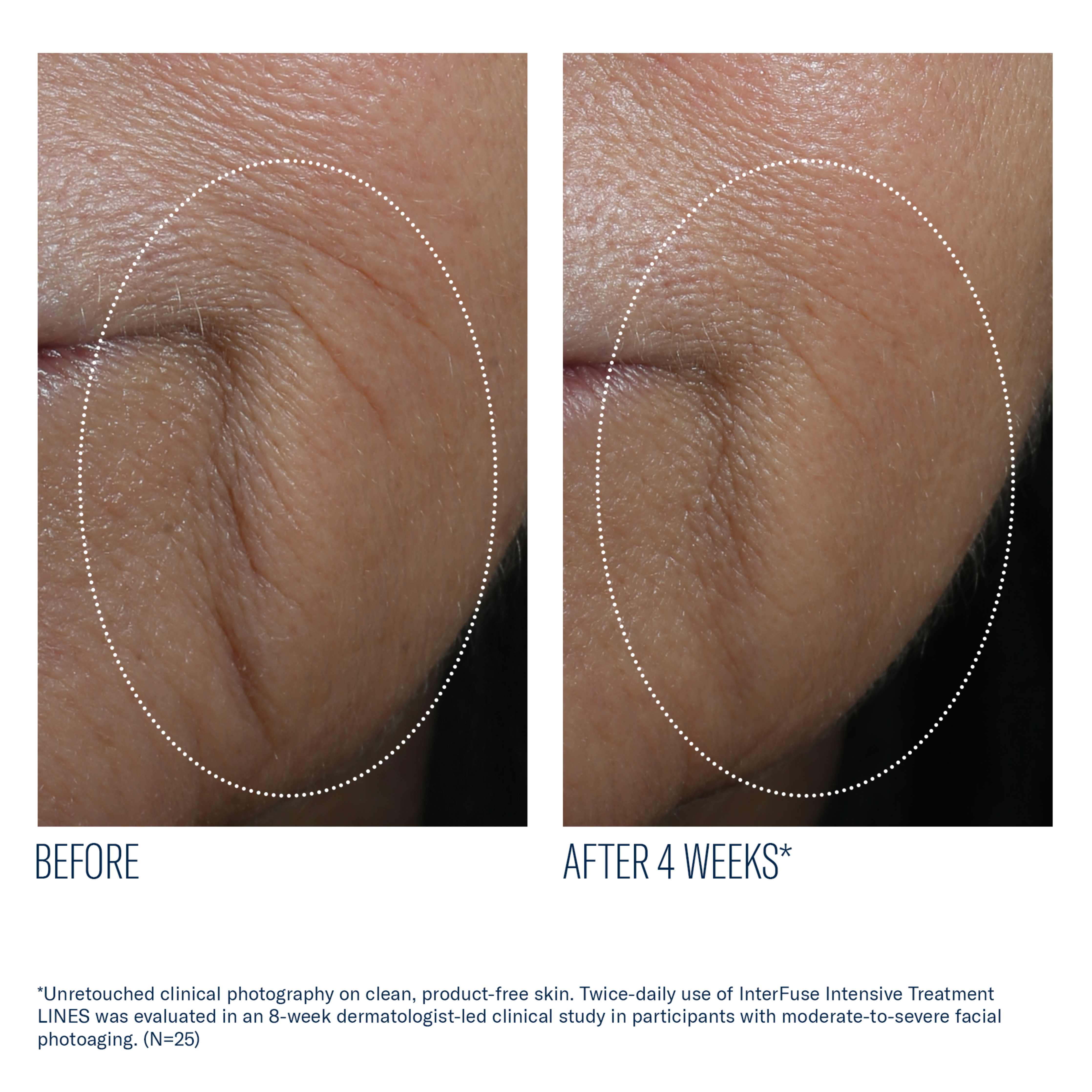 Before and after comparison of facial skin treatment showing reduced lines.
