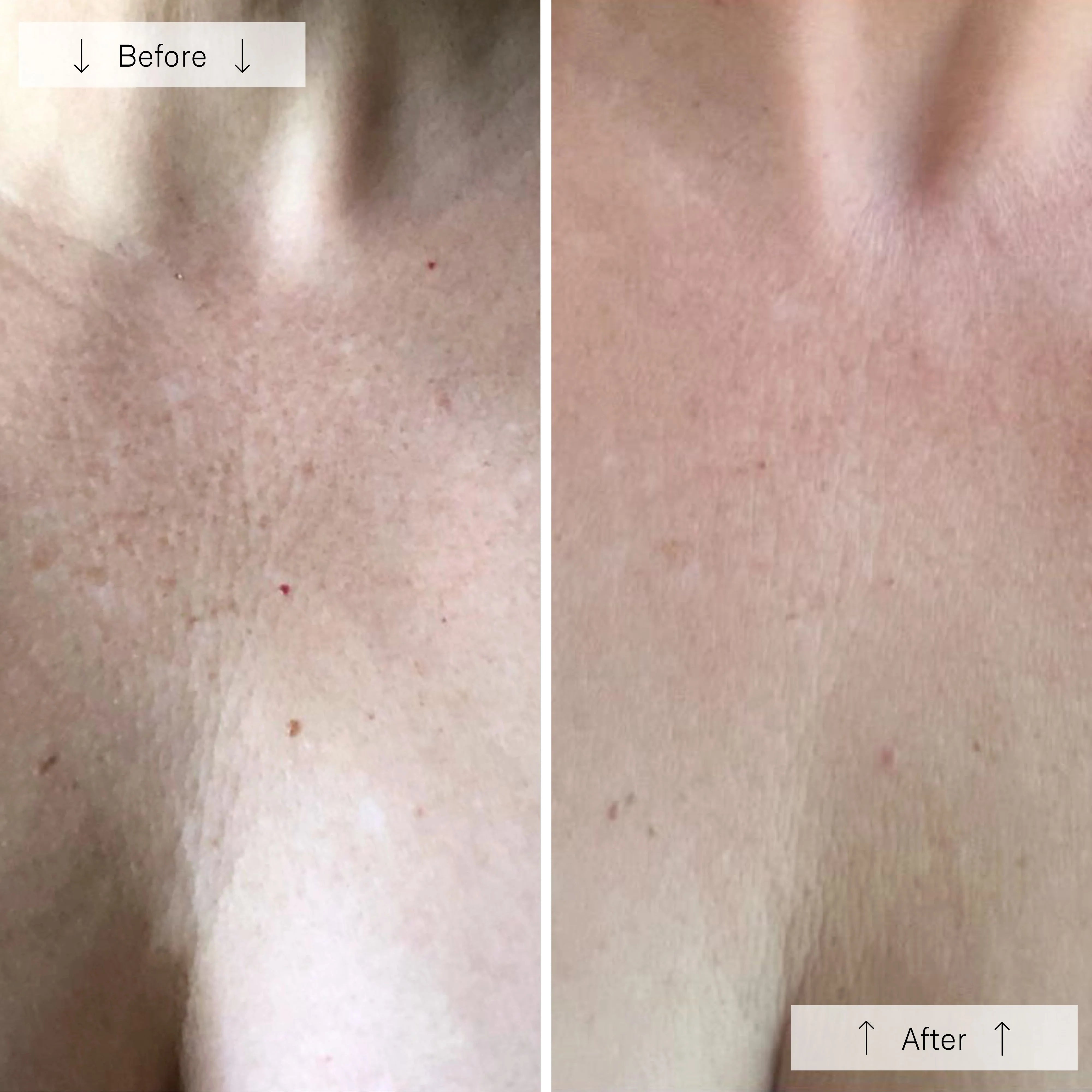 Before and after comparison of skin texture on a neck and chest.