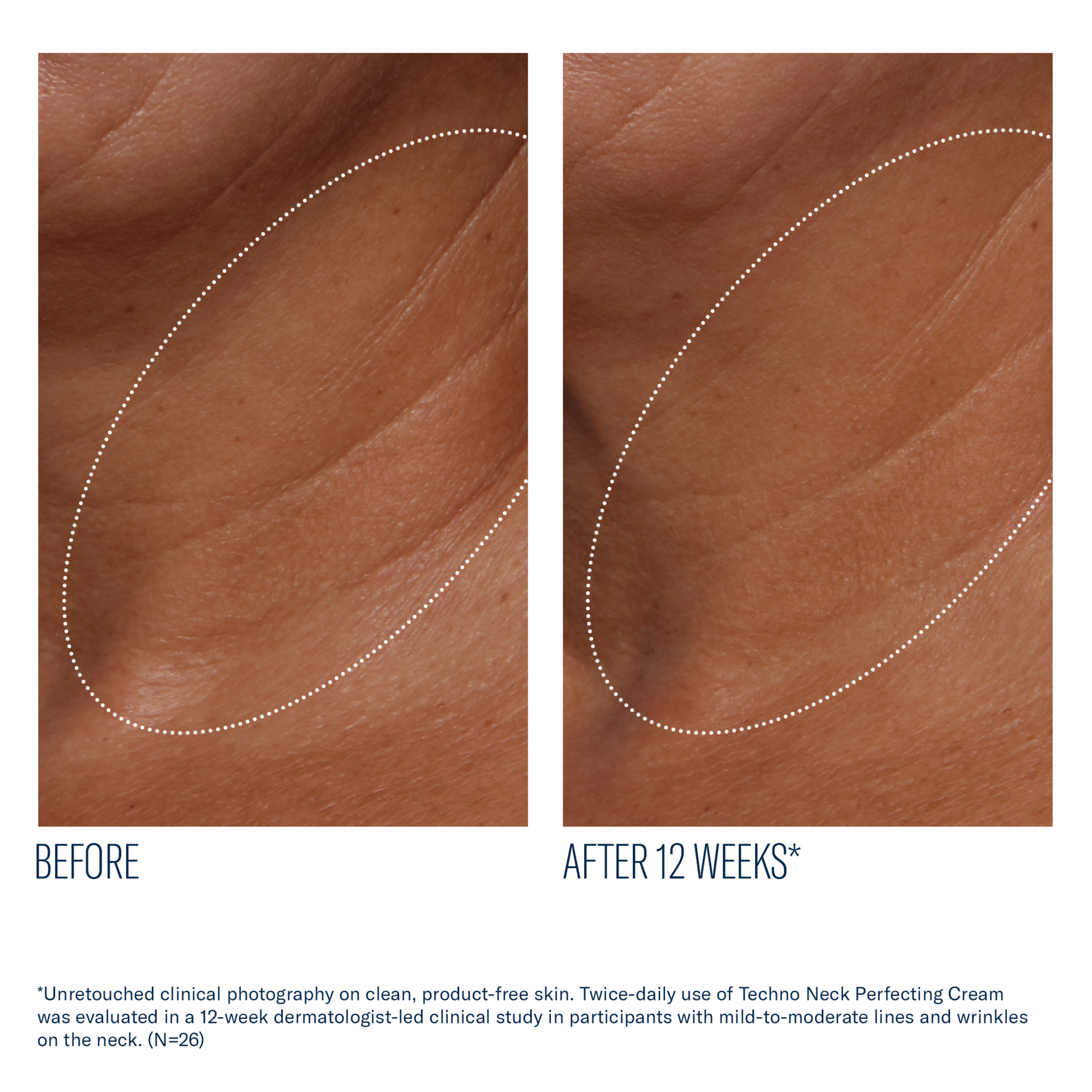 Before and after comparison of neck skin texture with a cream application over 12 weeks.